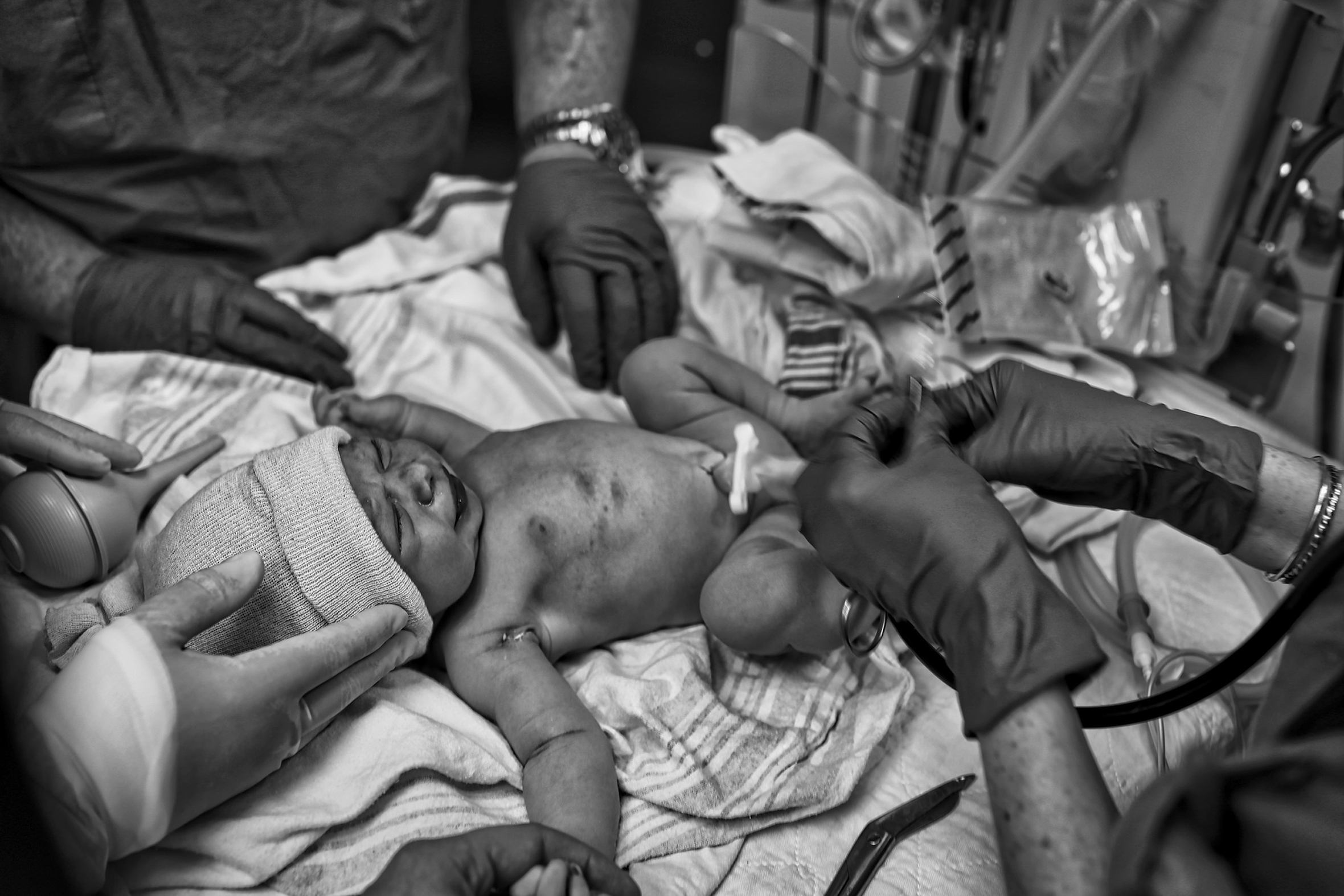 The author’s daughter moments after birth is on a table in the delivery room as she is attended to by three pairs of hands. The newborn has already acquired a knit cap.